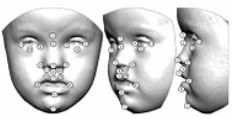 Extractos de té verde y desarrollo facial en el síndrome de Down 